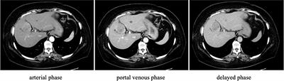 Case report: Unusual development of hepatocellular carcinoma during immunosuppressive treatments against rheumatoid arthritis overlapping Sjögren’s syndrome; cirrhotic steatohepatitis with liver inflammation and fibrosis lurks in autoimmune disorders